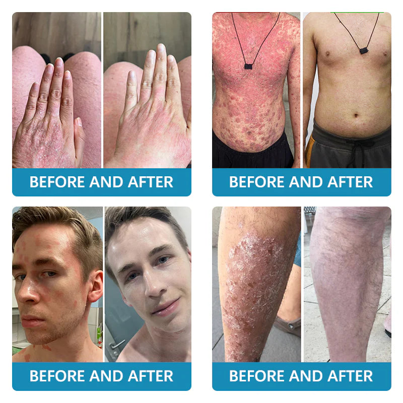 ✅EMA-Certified Ourlyard™ Advanced Multi-Symptom Psoriasis Treatment Cream👨⚕️Dermatologist Approved🔥75% OFF