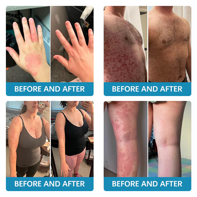 ✅EMA-Certified Ourlyard™ Advanced Multi-Symptom Psoriasis Treatment Cream👨⚕️Dermatologist Approved🔥75% OFF